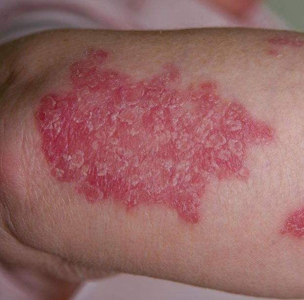 img-Psoriasis.jpg
