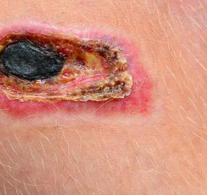 img-wound1.jpg